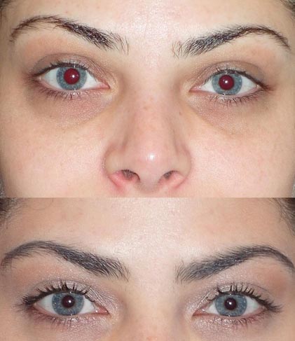 Two photos one on top of the other featuring a person's undereye area showing the before and after of getting undereye...